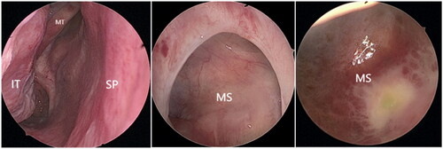 Figure 5. The nasal endoscopy A 45° endoscopic examination of the right anterior lacrimal saphenous fossa and the maxillary sinus at 3 months following surgery revealed excellent mucosal development and no indications of tumor growth. The right nasal cavity was still unobstructed.