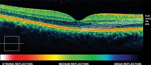 Figure 1 Normal eye high definition spectral domain optical coherence tomography (HD-OCT).