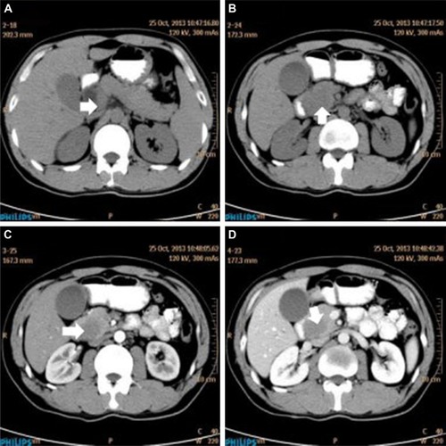 Figure 1 Abdominal CT findings. A CT scan showing diffuse hypodense enlargement of the pancreatic head (arrow).