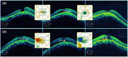 Figure 1 (L to R) Horizontal OCT cuts (with difference maps between images) preop, 2 month postop, and 1 year s/p vitrectomy. CMT was 215, 317, 203 OD and 318, 361, 335 OS respectively.