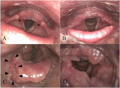Figure 3. Fiberoptic evaluation of a pregnant woman with laryngophayngeal reflux revealed erythema below the corniculate cartilages (A), a bacterial laryngitis showing erythema, edema and pus of the entire larynx (B). An erosive lesion on the epiglottis with ill-outlined borders in a case of supraglottic laryngeal carcinoma (C). Mass-like lesions in an extent form of laryngeal perichondritis (D).