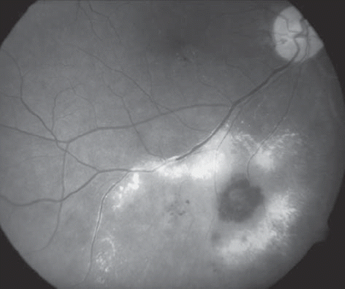 Figure 1. Fundus photograph of a right eye showing proliferative and exudative radiation retinopathy following brachytherapy with 106Ru for a choroidal melanoma. Note the vascular microaneurysm, intraretinal hemorrhage, and exudation from new and incompetent blood vessels.