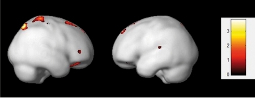 Figure 6. Regional correlations between gray matter density and individual differences in g (N =1 04). The design matrix controls for total gray matter