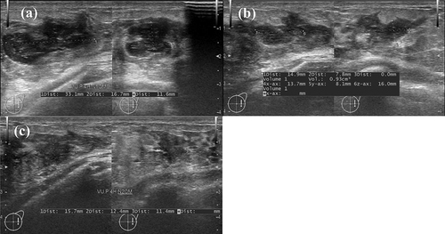 Figure 1 Illustration for a lactating breast abscess in early stage, obtained resolution after one aspiration. (a) at admission, ultrasound shows a fluid collection with capsule and peripheral edema. (b) Seven days post-aspiration, ultrasound shows a hypoechoic area corresponding to inflammatory tissue, with no remaining fluid collection and (c) 14 days post-aspiration, the hypoechoic area decreases significantly in size.