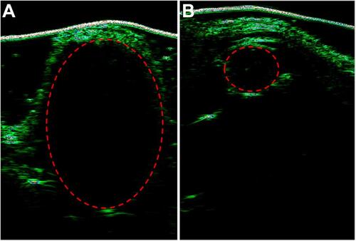 Figure 8 Ultrasounds of tumor-bearing mice treated with (A) PBS and (B) MSN(Mn)-ICG/DTIC.