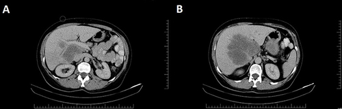 Figure 2 CT scan of thorax-abdomen-pelvis: (A) Hepatic tumor at the portal bifurcation; (B) Liver tumor at maximum diameter.