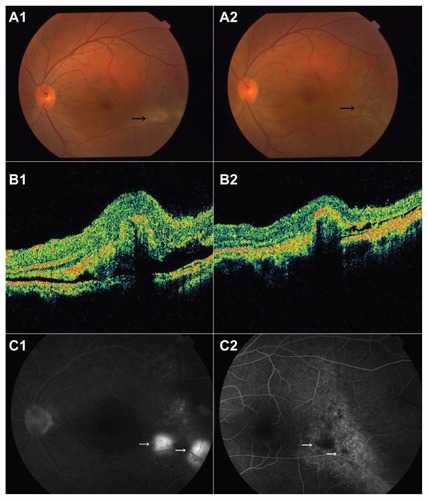 Figure 2 Case 2: Color fundus photography shows yellowish lesion inferotemporal to the fovea (black arrow) (A1). OCT shows subretinal fluid with fibrin and possible RPE elevation (B1). Fluorescein angiography shows two leakage points (white arrow) (C1). Post-treatment color photograph shows no yellowish exudate (black arrow) (A2). OCT shows decreased subretinal fluid and RPE detachment (B2). Fluorescein leakage had subsided (C2).