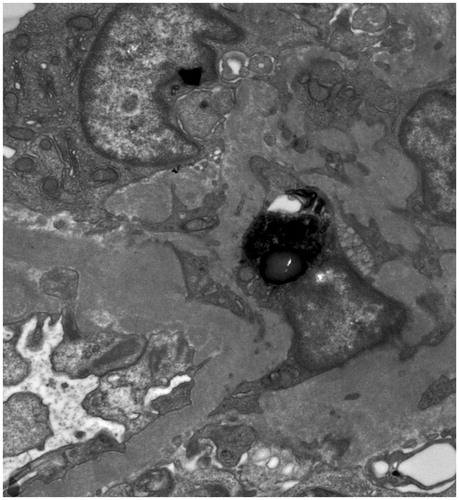 Figure 2. Electron microscopy of the kidney biopsy showing mesangial immune dense deposits.