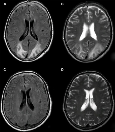 Figure 1 Axial brain MR images.