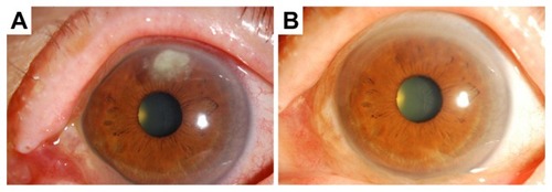 Figure 4 Case 4. (A) An upper peripheral corneal infiltrate with feathery margins. (B) Three months after starting treatment with antifungal agents, the cornea was clear, and the patient’s visual acuity was 1.0.