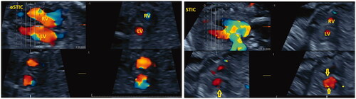 Figure 1. Paired comparison of color Doppler eSTIC vs STIC – plane B. Color Doppler e STIC (left) and STIC (right), B-plane (upper right and lower frames) reconstructed images obtained in a rapid sequence during the same study, corresponding to short axis (sagittal) views of fetal heart ventricles (LV: left ventricle; RV: right ventricle). Obvious distortion of ventricular contour in B-plane reconstruction (arrows right) in STIC frames resulting in inferior image quality compared to corresponding eSTIC B-plane frames.