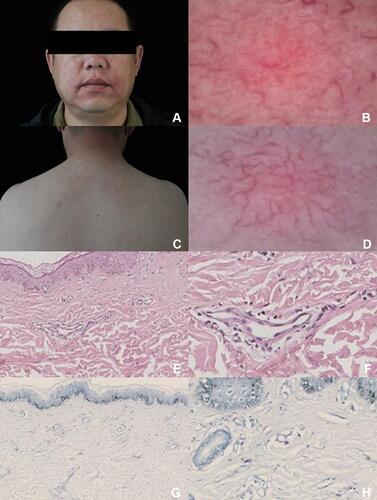 Figure 1 Clinical, dermoscopic, and histological images. (A and C) Physical examination showed the facial redness and flushing also erythematous-brownish macules and patches were widely distributed in his back area, with a few telangiectasias. (B and D) Dermoscopy imaging demonstrated the branching linear vessels of the facial lesion area and the branching linear vessels in a reticular pattern with a brown pigmentation network of the back area. (E, F, G and H) Telangiectasia in the upper dermis with perivascular mononuclear cells infiltration (Hematoxylin and Eosin-staining, original magnification ×40, ×200), displays the presence of mast cells (Toluidine-staining, original magnification ×40, ×200).