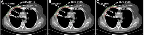 Figure 3 Distributions of location for CWR in all patients (A), patients with distance metastasis (B) and patients without metastasis (C).