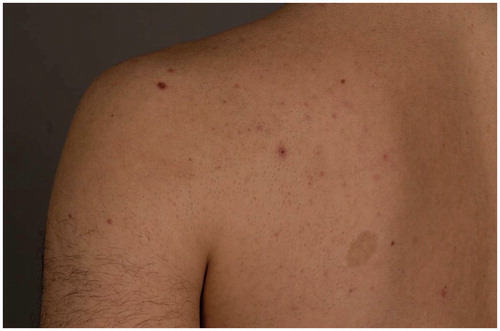 Figure 1. A 23-year-old male requested epilation of the back. He has nevi, acne papules, and café-au-lait spots in the treatment area (hair had been shaved 1 day before the photograph in preparation for laser treatment).