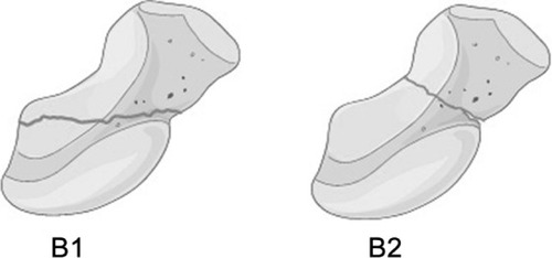 Figure 1 The Herbert classification of middle-third fractures: B1 distal oblique fracture and B2 complete waist fracture.