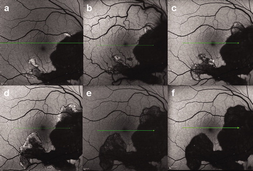 Figure 2. Fundus autofluorescence of serpiginous choroiditis. Progression despite anti-tuberculous treatment and oral prednisone (a–c). Exacerbation after mycophenolic acid was added (d). Remission after 1 month (e) and 1 year (f) with adalimumab monotherapy.