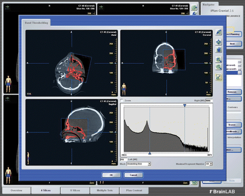 Figure 5. Intra-operative planning. Semi-automatic segmentation of the volumetric region of interest was performed on axial, coronal and sagittal reconstruction images windowed into bone-specific Hounsfield units using a specific cursor.