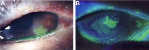 Figure 1 Slit lamp microscopic images of the left eye at the time of the initial presentation.