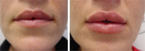 Figure 4 Before (left) and one month after (right) the treatment of upper and lower lips with 2 mL of cross-linked CMC.