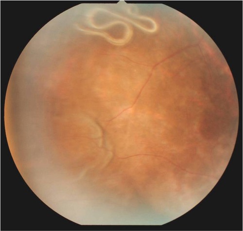 Figure 1 The subretinal parasite and subretinal tract at the superotemporal retina.