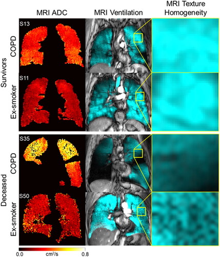 Figure 4. Hyperpolarized gas MRI for representative surviving and deceased ex-smokers with and without COPD. Coronal center-slice of MRI ADC and ventilation with corresponding qualitative and quantitative MRI texture heterogeneity. Top panel: A 63 yo male ex-smoker with COPD: FEV1=72%pred, FEV1/FVC = 50, BMI = 27 kg/m2, DLCO=79%pred, ADC = 0.38 cm2/s, VDP = 10%, RA950=10.8%, Shape-SVR=.43, Wavelet-LL-Skewness = 0.58; And a 66 yo female ex-smoker: FEV1=80%pred, FEV1/FVC = 76, BMI = 36 kg/m2, DLCO=80%pred, ADC = 0.24 cm2/s, VDP = 5.4%, RA950=2.3%, Shape-SVR=.45, Wavelet-LL-Skewness=.81; Bottom panel: A 78 yo male ex-smoker with COPD that died: FEV1=38%pred, FEV1/FVC = 39, BMI = 20 kg/m2, DLCO=30%pred, ADC = 0.55 cm2/s, VDP = 28%, RA950=24.9%, Shape-SVR=.62, Wavelet-LL-Skewness = 2.1; And a 64 yo female ex-smoker that died: FEV1=111%pred, FEV1/FVC = 82, BMI = 36 kg/m2, DLCO=68%pred, ADC = 0.26 cm2/s, VDP = 4.5%, RA950=1.2%, Shape-SVR=.48, Wavelet-LL-Skewness = 1.25.