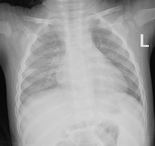Figure 3 This chest X-ray showed bronchopneumonia, which was significantly better than the previous X-ray.