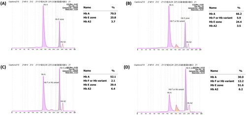 Figure 1. Representative capillary electropherograms of patients with classical heterozygous HbE with undetectable HbF (A), those with increasing HbF levels (B), HbE-β+-thalassemia with decreasing HbF expression (C), and classical HbE-β+-thalassemia with increasing HbF expression (D).