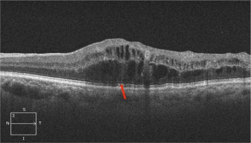 Figure 9 Central retinal vein occlusion associated with macular edema showing large cystic spaces associated with photoreceptor ISel band disruption (red arrow).