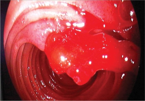 Figure 1 Endoscopic view of jejunal Dieulafoy’s lesion.