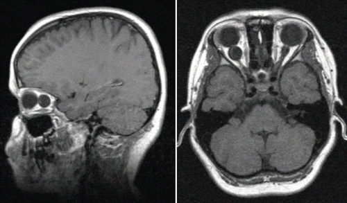 Figure 2. CT of the brain: right retroorbital cyst (sagital and transversal section).
