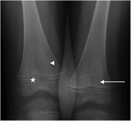 Figure 4. Lower limbs X-ray showing Trummerfeld zone (arrow), Frankel’s lines (arrow head) and enlarged metaphyseal margin (star)