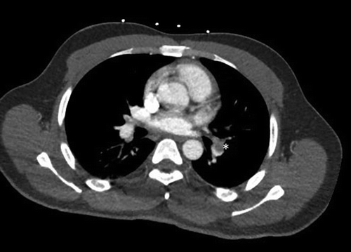 Figure 4. CTA of lungs showed moderate-sized filling defects in the left lower lobe consistent with pulmonary embolism (asterisk *)