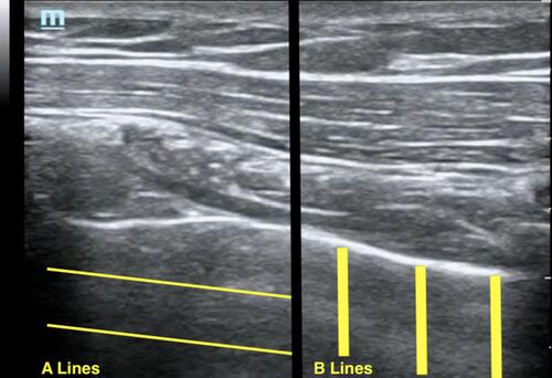 Figure 4 Sonographic images of the lung with the orientation of A lines and B lines superimposed.