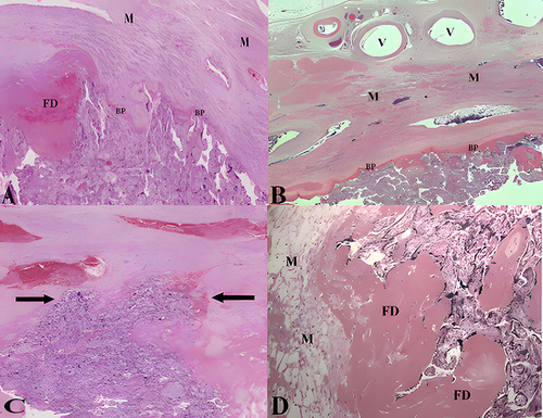 Figure 5 Histopathological diagnosis of placenta accreta spectrum. (A) Myometrial section under the invasive area (H & E x 2.0). The infiltrating villi were surrounded by irregular and undulating basal plate (BP), and there was thick fibrin deposition (FD) around the infiltrating anchored villi. (B) Thick myometrial section of the uterine wall under the close villi to the basal plate (BP) without attaching the decidua (H & E x 1.5). Pay attention to the disorder of muscle fibers, tissue edema of lower myometrium (M), and the presence of large blood vessels (V). (C) Deep villous infiltration area with the absence of the decidual layer between the two black arrows (H & E X 2.9). (D) Infiltrating villi and edematous myometrium (M) were separated by thick wall fibrin deposition (FD) (H & E X 10.0).