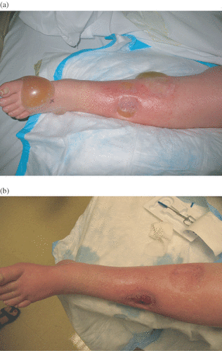 Figure 1. Panel A depicts Weiberdink regional toxicity grade III 6 days after an isolated limb infusion. Notice the erythema, edema and severe blistering of the skin. Panel B shows resolution of these toxicities by the 6 week post-operative visit.