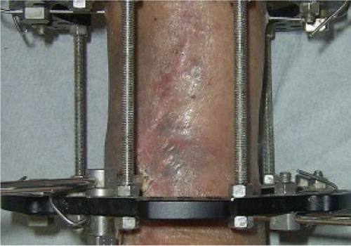 Fig. 9 Clinical picture showing the soft tissue defect healed at 6 months after the Papineau technique.