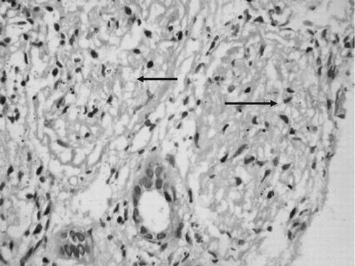 Figure 2. Renal cortical necrosis. Renal biopsy shows necrosis of two glomeruli (H&E, ×300).