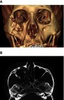Figure 3 Postoperative facial bone CT (computed tomography). (A) 3D imaged photo. (B) Transverse section of CT.