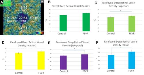 Figure 5 (A) The foveal and parafoveal DRVD maps. (B) No significant difference is seen between the two groups in the foveal DRVD. (C) The superior parafoveal DRVD is significantly greater in the FEVR group compared with the control group (*p<0.05). (D) No significant difference is seen between the two groups in the inferior foveal DRVD. (E) The temporal parafoveal DRVD is significantly greater in the FEVR group compared with the control group (*p<0.05). (F) The nasal parafoveal DRVD is significantly greater in the FEVR group compared with the control group (*p<0.05).