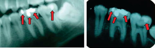 Figure 3. Periapical radiological confrontation showing some of the elements used for the positive identification: anatomy, angulation, and proportion of the first and second lower molars; the location, morphology, and proportion of dental treatments (red arrows) of the first and second lower molars. (A) Antemortem examination in 2009 provided by family members of the missing person. (B) Postmortem examination of the unidentified body performed by the forensic team in 2014.