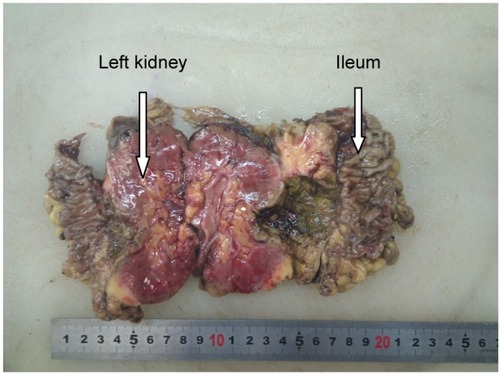 Figure 4 Specimen resected demonstrating partial ileum adhesive to the ablative area of the renal tumor.