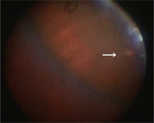 Figure 4 Intraoperative endoscopic finding of depigmentation (arrow) at the sclerotomy site after the cannula was removed. Although it is difficult to confirm no vitreous incarceration in the photograph, the absence of triamcinolone acetonide particles suggests that there is no vitreous incarceration at the sclerotomy site.