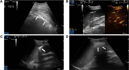 Figure 1 (A) Crescent-shaped hematoma around the spleen as detected by sonography (arrowheads). (B) Enhanced hemorrhage of puncture tract on contrast-enhanced ultrasound (CEUS). (C) Ultrasound (US)-guided microwave electrode was set into the hemorrhage region (arrowhead). (D) After ablation, enhancement was not detected in the ablation zone (arrowheads).