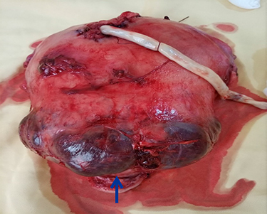 Figure 3 Hysterectomy specimen illustrating bulging placenta through the serosa of the lower segment (arrow).