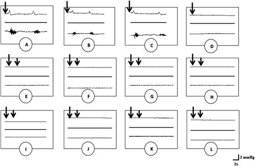 Figure 2. Polygraphic intraseminal pressure (upper) and EMG (lower) tracings showing the effects of dopamine (0.1 μmol/kg) (A), aqueous extract (B) and methanol extract (C) of G. tessmannii (20 mg/kg), haloperidol (0.26 μmol/kg) plus aqueous extract of G. tessmannii (20 mg/kg) (D), sulpiride (0.26 μmol/kg) plus aqueous extract of G. tessmannii (20 mg/kg) (E), Sch23390 (0.26 μmol/kg) plus aqueous extract of G. tessmannii (20 mg/kg) (F), haloperidol (0.26 μmol/kg) plus methanol extract of G. tessmannii (20 mg/kg) (G), sulpiride (0.26 μmol/kg) plus methanol extract of G. tessmannii (20 mg/kg) (H), Sch23390 (0.26 μmol/kg) plus methanol extract of G. tessmannii (20 mg/kg) (I), haloperidol (0.26 μmol/kg) plus dopamine (0.1 μmol/kg) (J), sulpiride (0.26 μmol/kg) plus dopamine (0.1 μmol/kg) (K), Sch23390 (0.26 μmol/kg) plus dopamine (0.1 μmol/kg) (L) on the bulbospongiosus muscles and seminal vesicles, respectively. Long and short arrows indicate the first and second injections, respectively.