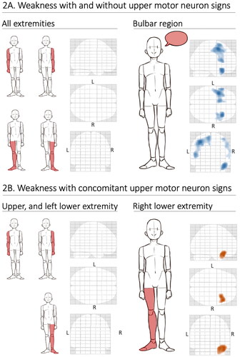 Figure 2 (A–B) Brain metabolic alterations on FDG-PET imaging in relation to focal weakness in ALS. Including focal weakness with and without upper motor neuron (UMN) signs (A) and only including focal weakness with concomitant UMN signs (B). Blue indicates areas of relative hypometabolism, and orange indicates relative hypermetabolism (difference only appreciable in color version). Regions that were not associated with specific alterations are shown to the left in both A and B and the regions that were associated with specific alterations (bulbar and right lower extremity, respectively) are shown to the right. The bulbar region was not included in B since UMN signs in this area are difficult to appreciate on clinical examination. FDG-PET: fluorodeoxyglucose-positron emission tomography; L: left; R: right.