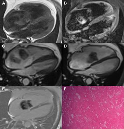 Figure 1 A 30-year-old male patient, the lesion in the right atrial. (A) the lesion presented isointense signals on T1WI (four-chamber heart); (B) the lesion presented hyper-intensive signals fat-suppressed T2WI (four-chamber heart); (C) Four-chamber cine sequence of the ventricular systolic phase presented right atrial space-occupying; (D) During diastolic phase, the four-chamber cine presented that the right atrium mass entered the right ventricle with blood flow; (E) The delayed enhanced four-chamber sequence presented inhomogeneous enhancement on the margin of the lesion; (F) The pathological findings indicated myxoma (H&E, × 200).