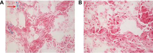 Figure S5 Iron from M-MSNs was revealed by Prussian blue staining.Notes: (A) Tumor slide after injection of M-MSN_NC siRNA@PEI-PEG-KALA (red arrow points to the iron accumulated in tumor region). (B) Liver tissue from animals that were not injected with nanocarriers, but the equivalent saline. Magnification was 20×.Abbreviations: M-MSN, magnetic mesoporous silica nanoparticles; PEI, polyethylenimine; PEG, polyethylene glycol; KALA, a type of fusogenic peptide; NC siRNA, negative control small interfering RNA.