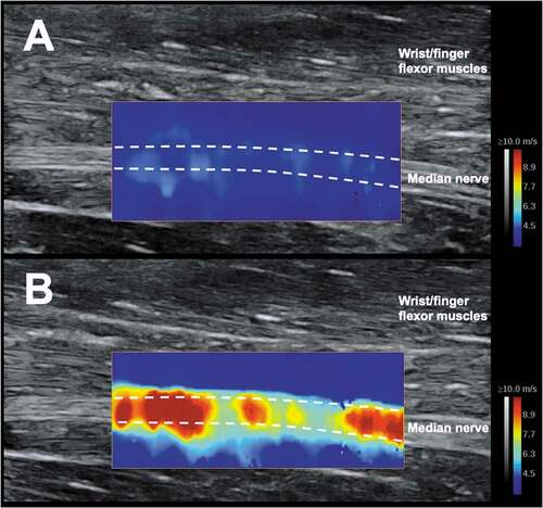 Figure 3. The median nerve, imaged using shear wave elastography, at the level of the mid-forearm when (A) relaxed and (B) when on stretch. Note: colored elastogram presents nerve shear wave velocity (metres/sec) (an index of nerve stiffness).