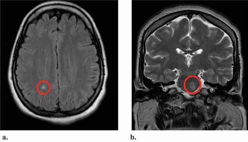 Figure 1. (a) and (b) Magnetic resonance imaging of the brain demonstrating demyelinating disease. Multi-slice/multi-sequence study of the brain performed without and with administration of gadolinium. There are multiple round white matter hyperintensities seen on FLAIR concerning for demyelinating disease (red circle) Figure (a). There is a rounded lesion in the left pons without mass effect (red circle) Figure (b)